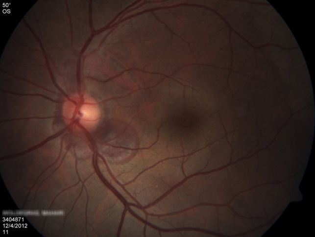 Choroidal Rupture And Peripapillary Hemorrhage Choroidal Rupture And Peripapillary Hemorrhage