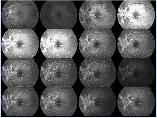 Fluorescein Angiography 1 In Patient With PXE Fluorescein Angiography 1 In Patient With PXE