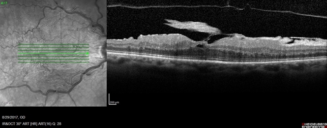 OCT Image Of Epiretinal Membrane OCT Image Of Epiretinal Membrane