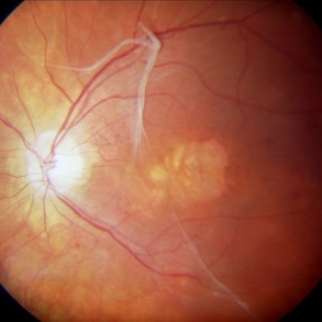 Spontaneous Epiretinal Membrane Separation Spontaneous Epiretinal Membrane Separation