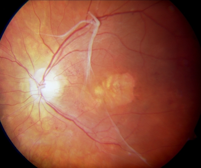 Spontaneous Epiretinal Membrane Separation Spontaneous Epiretinal Membrane Separation