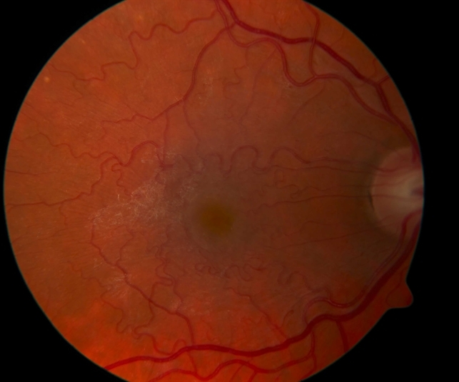 Macular pucker colour retina image bank