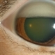 Anterior Segment Photo of Emulsified Silicone Oil