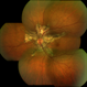 Angioid Streaks
