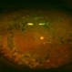 Fundus Panorama: Post Operative Findings of Tractional Retinal Detachment