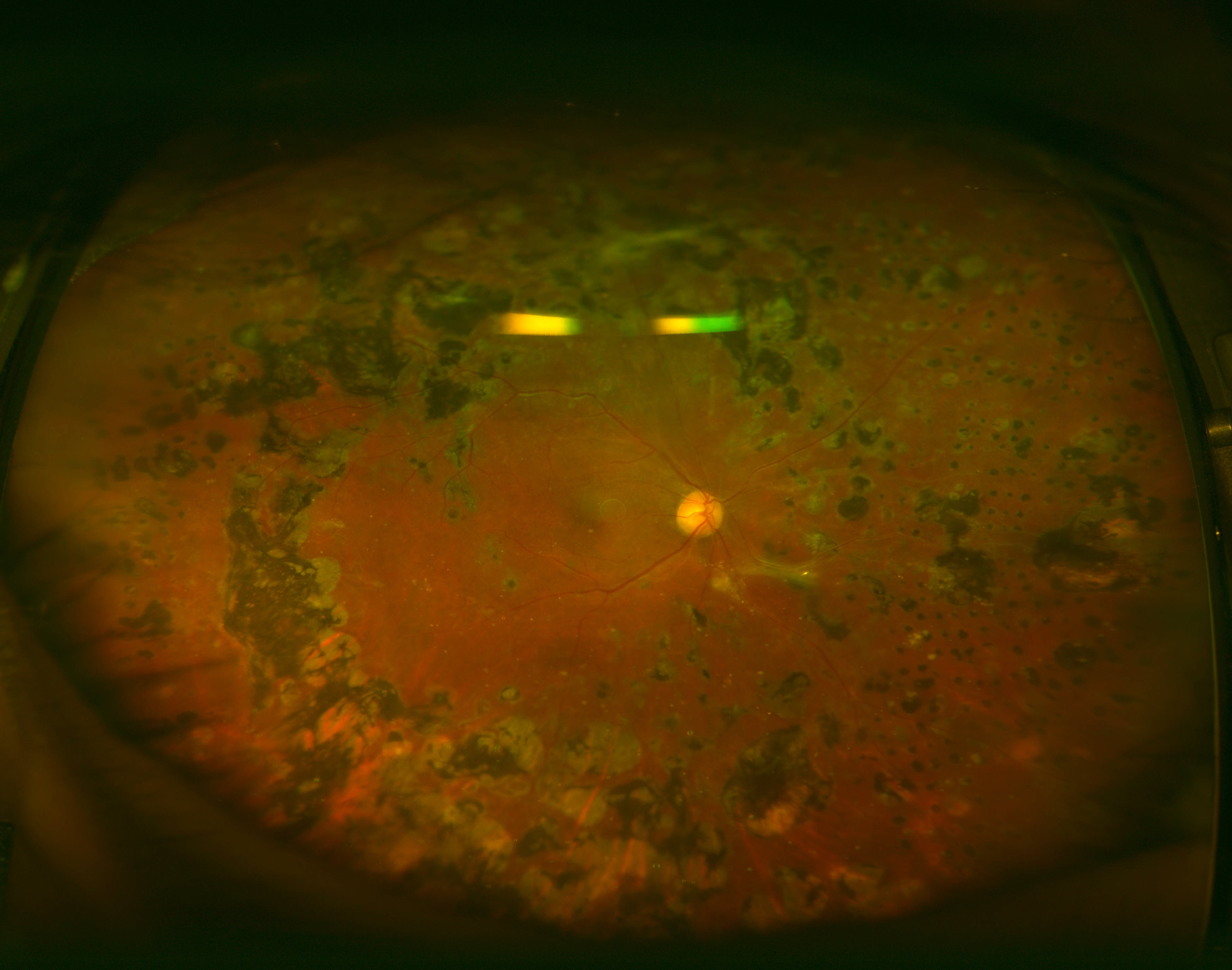 tractional retinal detachment