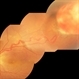 Retinal Capillary Hemangioma Retinal Capillary Hemangioma
