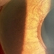 Regression of Iris Neovascularization After Intravitreal Bevacizumab
