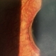 Advanced Stage of Neovascular Glaucoma Advanced Stage of Neovascular Glaucoma