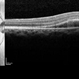 Central Serous Retinopathy with Fibrin Central Serous Retinopathy with Fibrin
