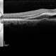 Central Serous Retinopathy with Fibrin Central Serous Retinopathy with Fibrin