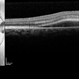 Central Serous Retinopathy with Fibrin Central Serous Retinopathy with Fibrin