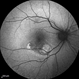 Polypoidal Choroidal Vasculopathy