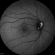 Optic Disc Drusen Optic Disc Drusen