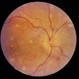 Malignant Hypertension