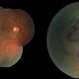 Collar Button Choroidal Melanoma Collar Button Choroidal Melanoma