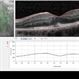 Possible Uveitis or RP Variant Possible Uveitis or RP Variant