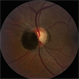 Optic Disc Melanocytoma Optic Disc Melanocytoma