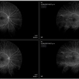 Fluorescein Angiography in Choroidal Rupture