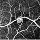 Retinal Macroaneurysm (RAM) Retinal Macroaneurysm (RAM)