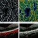 OCTA of Diabetic Retinopathy OCTA of Diabetic Retinopathy