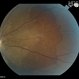 Choroidal Hemorrhage from Hypertensive  Choroidopathy Choroidal Hemorrhage from Hypertensive  Choroidopathy