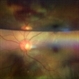 Submacular haemorrhage  PCV Submacular haemorrhage  PCV
