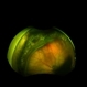 Retinopathy of Prematurity