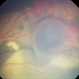Serous Retinal Detachment in Coats Disease Serous Retinal Detachment in Coats Disease