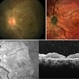 Foveal Thinning Post Blunt Trauma Foveal Thinning Post Blunt Trauma