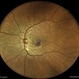 Subretinal Neovascular Membrane