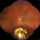 Retinal detachment Retinal detachment