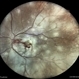 Multifocal Chorioretinitis