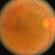 Hypertension With Arterio-Venous Nicking and a Superior Macular BRVO with CME Hypertension With Arterio-Venous Nicking and a Superior Macular BRVO with CME