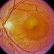 Central Serous Chorioretinopathy (CSR)