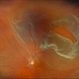 Retinal Detachment with Multiple Breaks Retinal Detachment with Multiple Breaks