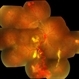 Von Hippel-Lindau Syndrome Von Hippel-Lindau Syndrome