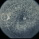 Macular Hole Evolving / Lamellar Hole Macular Hole Evolving / Lamellar Hole
