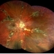 Paravenous-Pigmented-Retinochoroidal-Atrophy