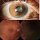 Sectoral Ocular Melanocytosis Sectoral Ocular Melanocytosis