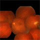Toxo Lesion Toxo Lesion