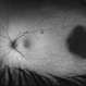 Congenital hypertrophy of the retinal pigment epithelium (CHRPE) Congenital hypertrophy of the retinal pigment epithelium (CHRPE)