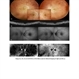 Idiopathic Choroidal Folds-Multimodal Imaging Idiopathic Choroidal Folds-Multimodal Imaging