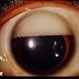 Inverted Hypopyon - Silicon Oil Complication Inverted Hypopyon - Silicon Oil Complication