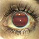 Silicone oil in traumatic aniridia