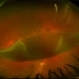 Retinal Detachment with Giant Tear Retinal Detachment with Giant Tear