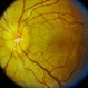 Disc Edema