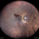 Neovascularization Elsewhere in a Case of Proliferative Diabetic Retinopathy Neovascularization Elsewhere in a Case of Proliferative Diabetic Retinopathy