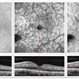 Paracentral Acute Middle Maculopathy Paracentral Acute Middle Maculopathy