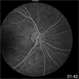 Radiation Retinopathy Radiation Retinopathy